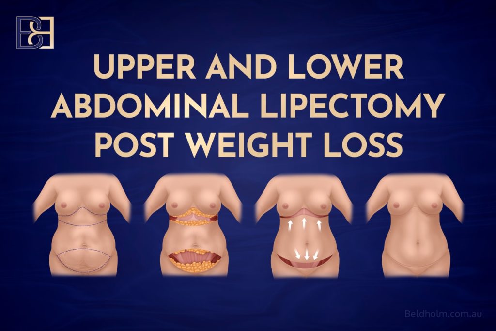 Upper and Lower Abdominal Lipectomy Post Weight Loss, a Highly Selective Body Contouring Option for Uncommon Anatomical Patterns 1 Upper and Lower Abdominal Lipectomy Post Weight Loss