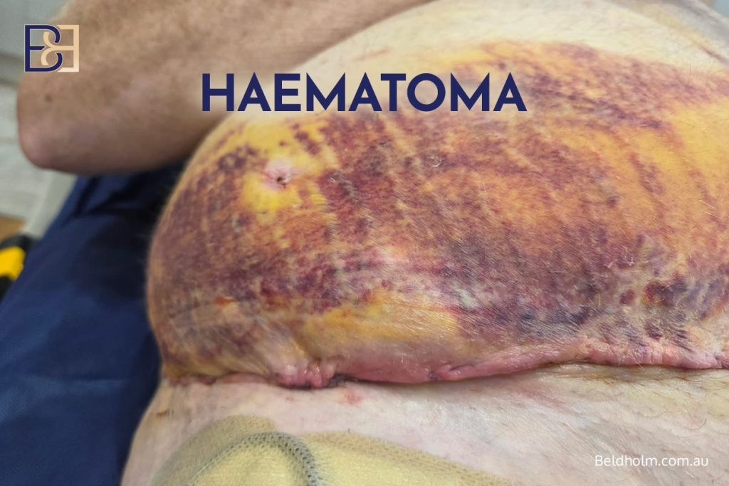 Upper and Lower Abdominal Lipectomy Post Weight Loss, a Highly Selective Body Contouring Option for Uncommon Anatomical Patterns 8 Haematoma post abdominoplasty | Dr Bernard Beldholm