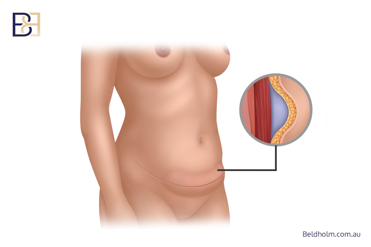 Complications of Circumferential Hybrid Abdominoplasty (Combined Vertical with Circumferential Abdominoplasty) 6 Abdominal seroma | Dr Bernard Beldholm