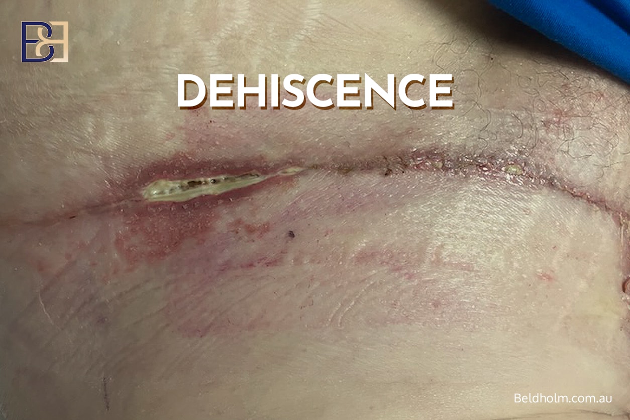 Complications of Circumferential Hybrid Abdominoplasty (Combined Vertical with Circumferential Abdominoplasty) 5 wound dehiscence | Dr Bernard Beldholm