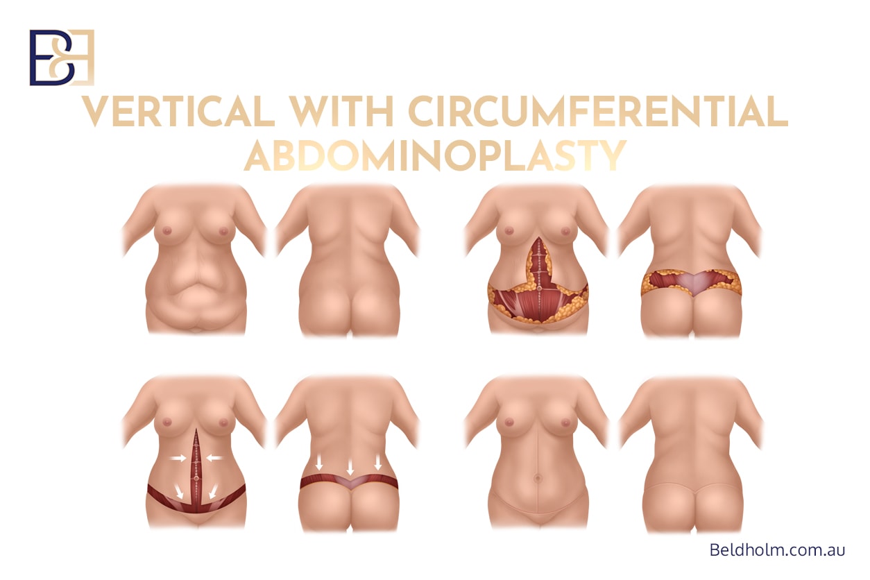 Complications of Circumferential Hybrid Abdominoplasty (Combined Vertical with Circumferential Abdominoplasty) 1 Circumferential hybrid abdominoplasty | Dr Bernard Beldholm