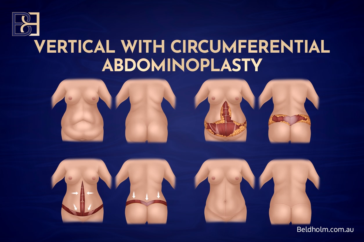 Recovery After a Circumferential Hybrid Abdominoplasty 1 Circumferential hybrid Abdominoplasty | Dr Bernard Beldholm