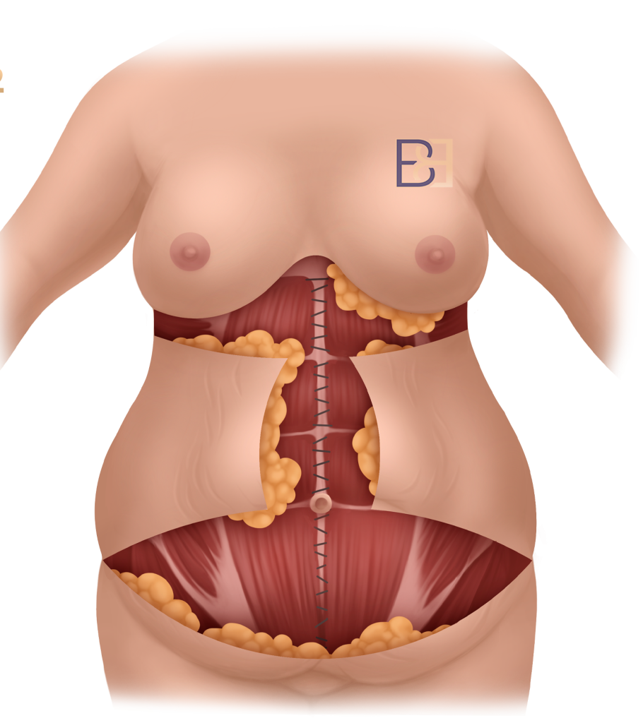 Abdominal Muscle Considerations