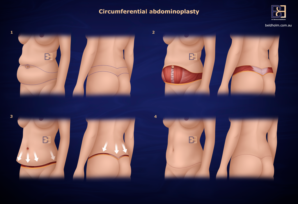 An illustration showing the concept of body lift (belt lipectomy) surgery