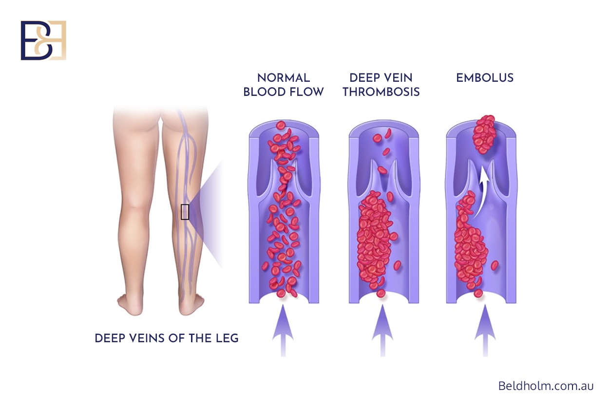 Apronectomy Post Weight Loss in Newcastle NSW 5 DVT