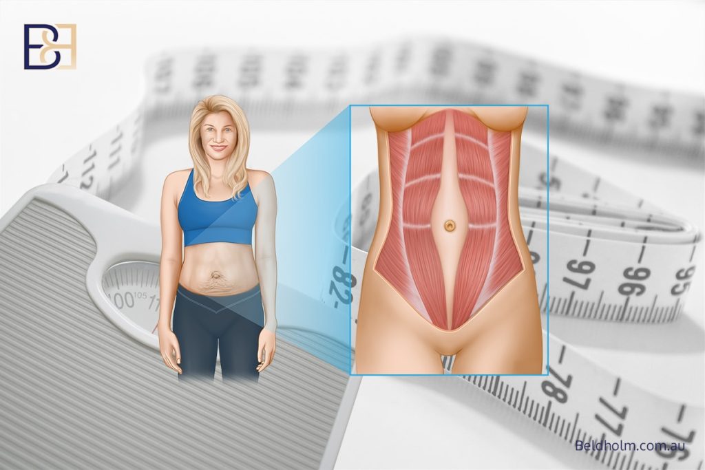 Excess Skin After Weight Loss – Surgical Options for the Abdomen and Lower Torso 2 Diastasis recti Landing