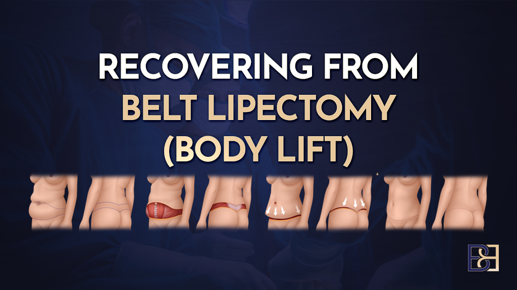 Recovering from Belt Lipectomy (also known as Lower Body Lift)