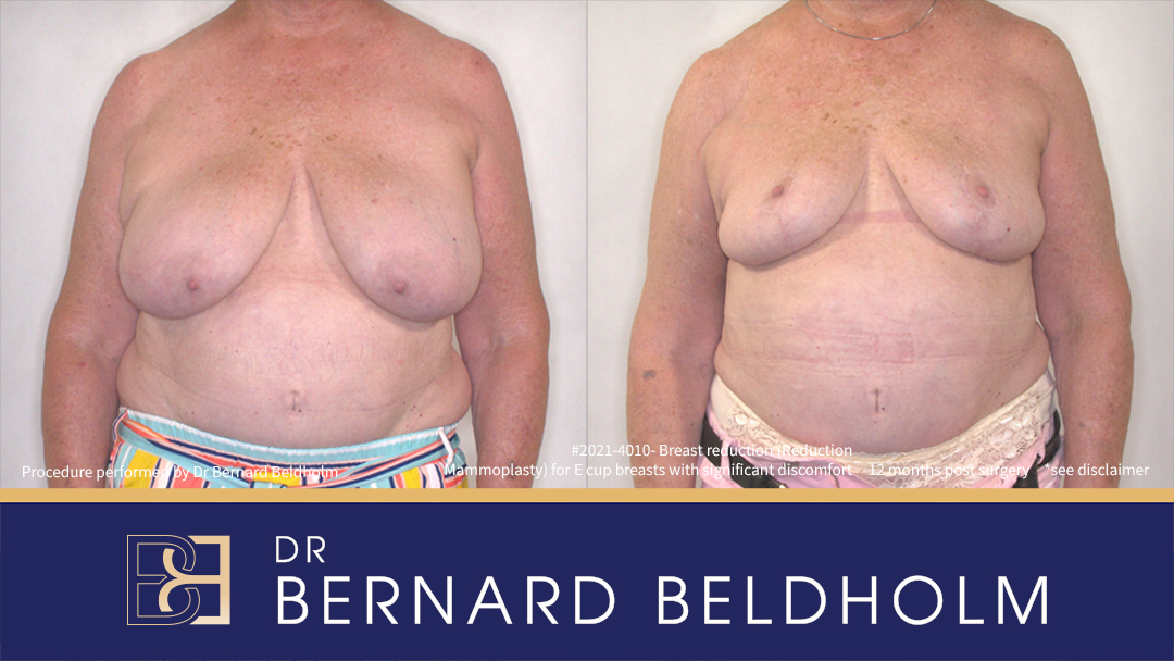 Breast Reduction (Reduction Mammoplasty) for E Cup Breasts with Significant Discomfort (Patient 2021-4010)