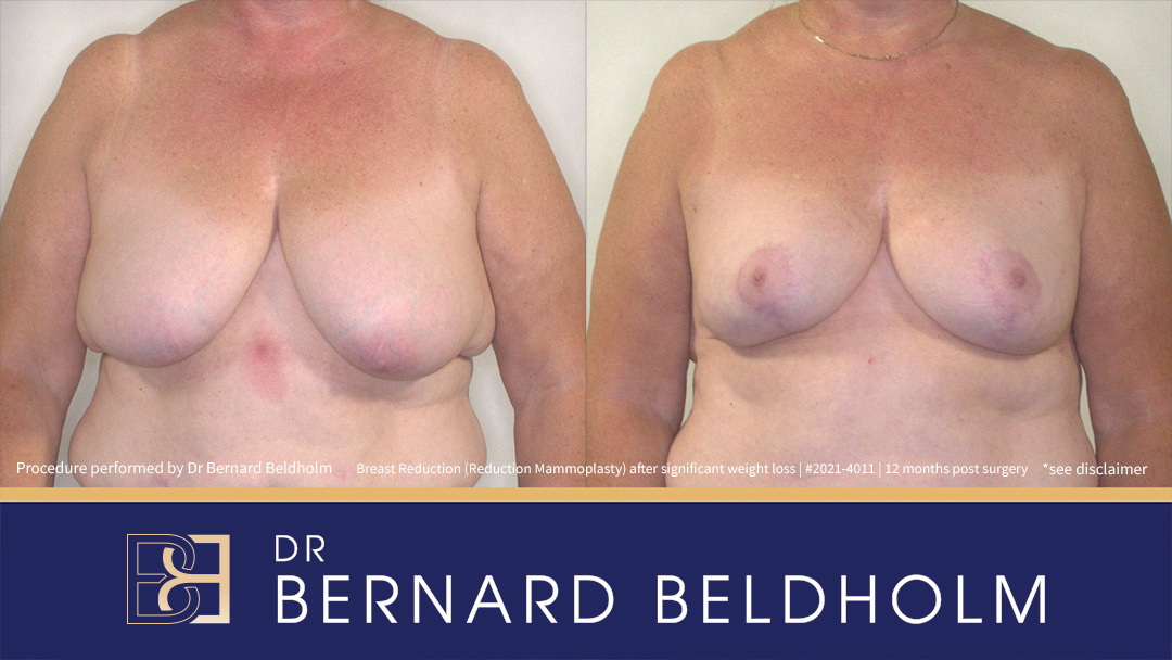 Breast Reduction (Reduction Mammoplasty) After Significant Weight Loss, F-Cup Breasts with Ptosis (Patient 2021-4011)