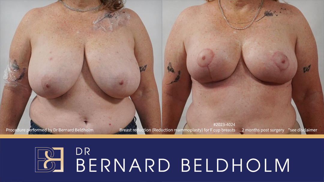Breast Reduction (Reduction Mammoplasty) for F Cup Breasts (Patient 2023-4024) - Front