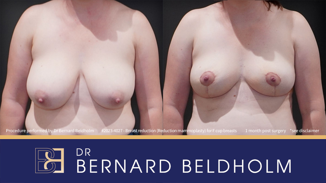 Breast Reduction (Reduction Mammoplasty) for F Cup Breasts (Patient 2023-4027) - Front