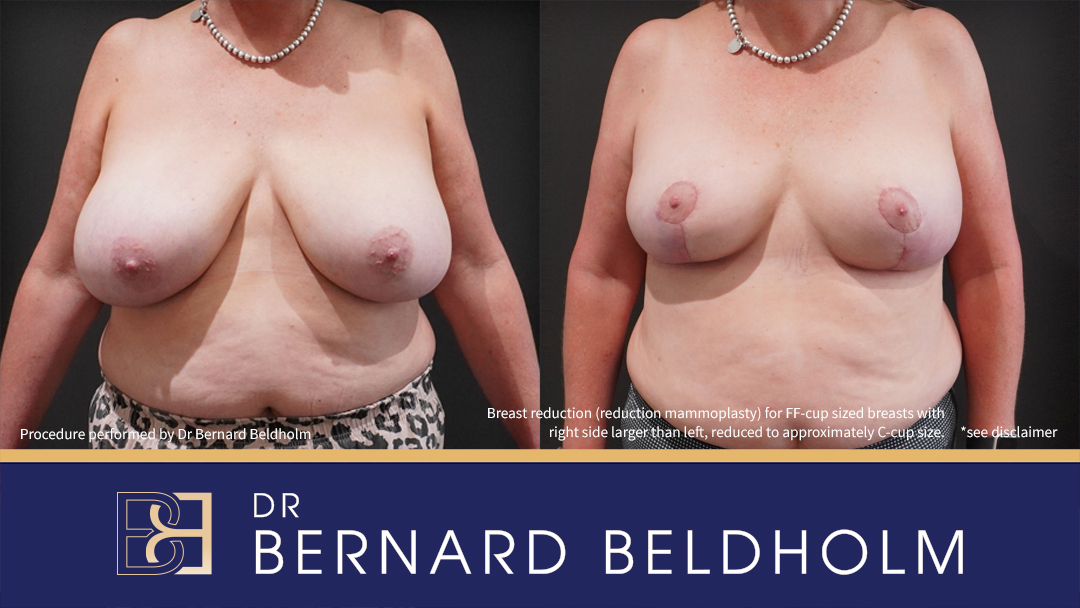 Breast Reduction (Reduction Mammoplasty) for FF Cup Size Breasts (Patient 2022-4007)