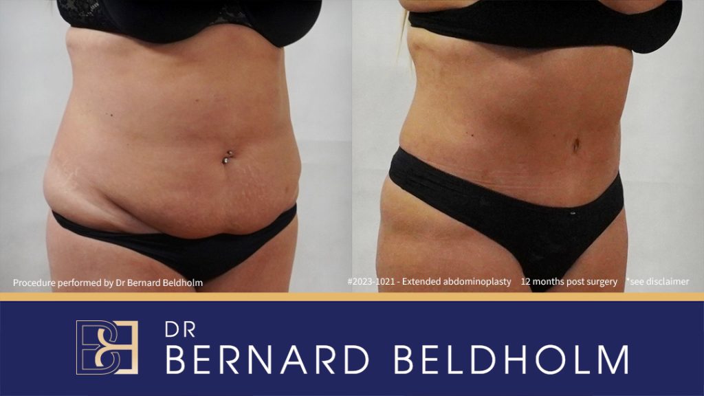 Abdominoplasty Post Weight Loss with VASER Liposuction (Suction-assisted Lipectomy) and Diastasis Recti Repair (Patient 2023-1021) - Left