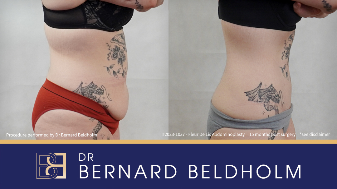 Fleur de Lis Abdominoplasty After Loosing 50kg of Weight (Patient 2023-1037) - Left Side
