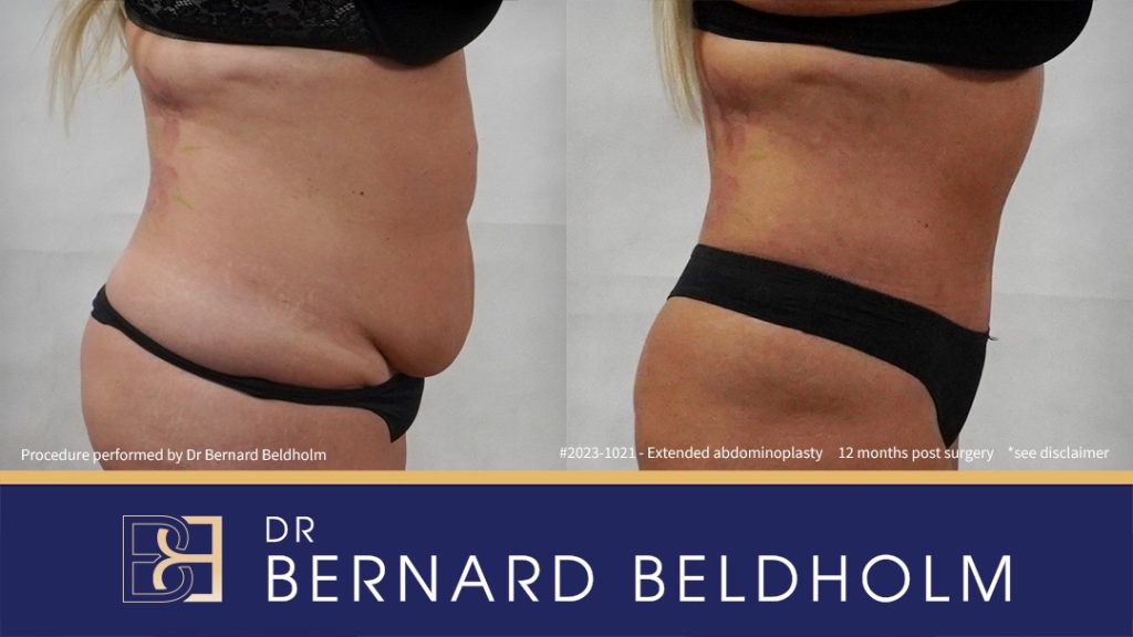 Abdominoplasty Post Weight Loss with VASER Liposuction (Suction-assisted Lipectomy) and Diastasis Recti Repair (Patient 2023-1021) - Left Side