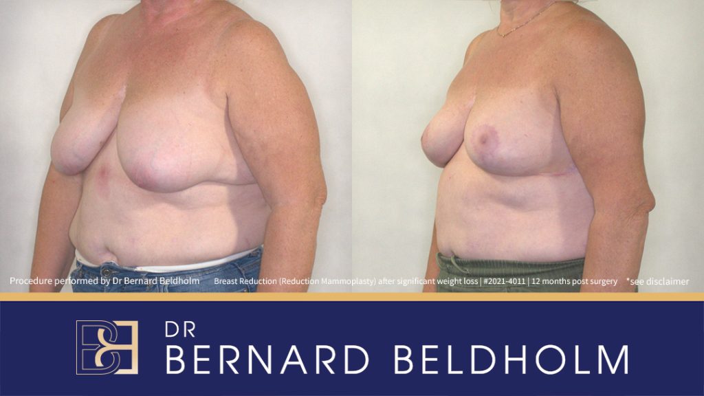 Breast Reduction (Reduction Mammoplasty) After Significant Weight Loss, F-Cup Breasts with Ptosis (Patient 2021-4011) - Right