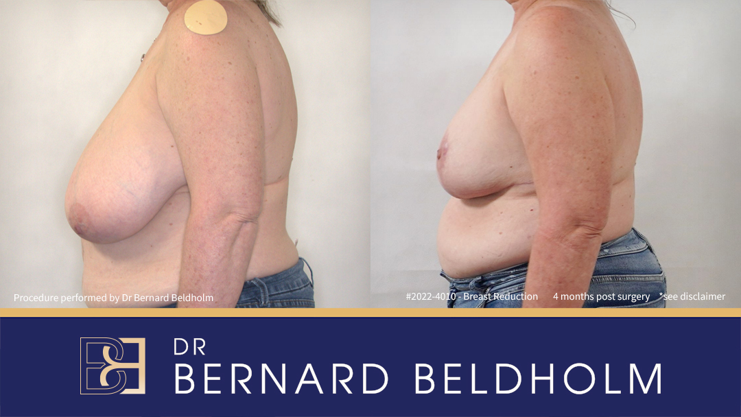 Breast Reduction (Reduction Mammoplasty) for G Cup Uneven Breasts (Patient 2022-4010) - Right Side