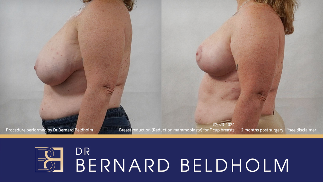 Breast Reduction (Reduction Mammoplasty) for F Cup Breasts (Patient 2023-4024) - Right Side