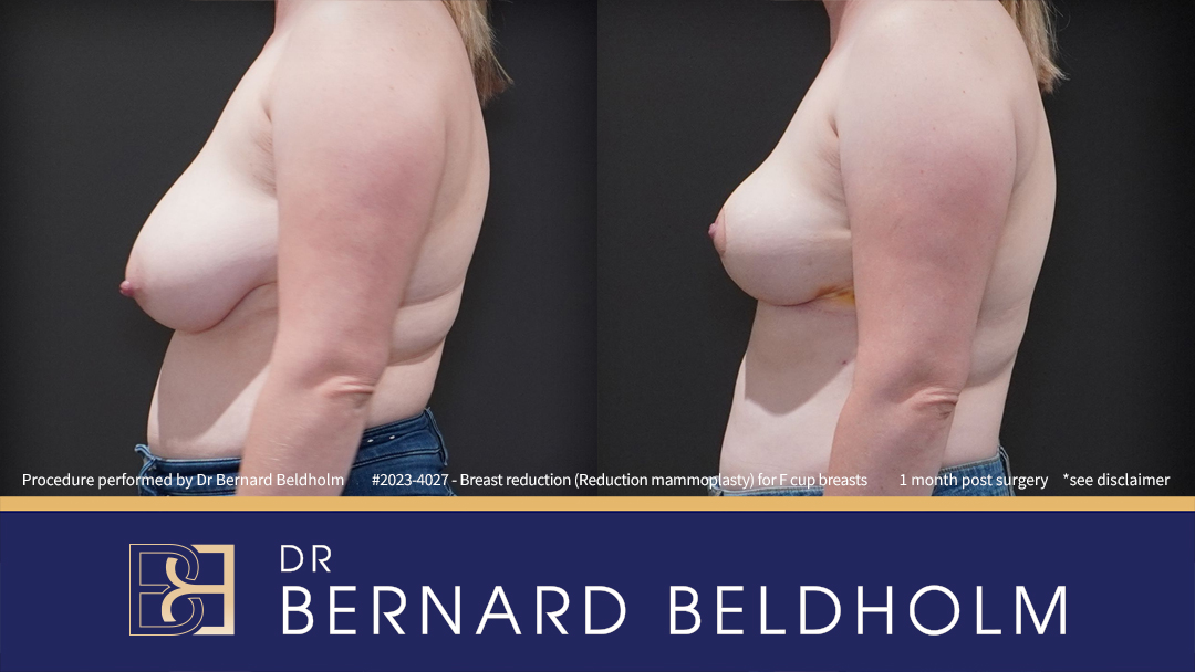 Breast Reduction (Reduction Mammoplasty) for F Cup Breasts (Patient 2023-4027) - Right Side