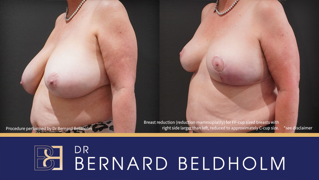 Breast Reduction (Reduction Mammoplasty) for FF Cup Size Breasts (Patient 2022-4007) - Right