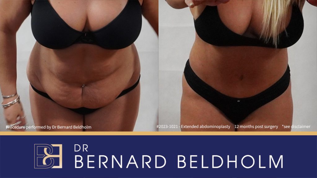 Abdominoplasty Post Weight Loss with VASER Liposuction (Suction-assisted Lipectomy) and Diastasis Recti Repair (Patient 2023-1021) - Front Bend