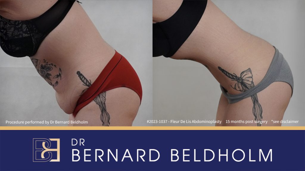 Fleur de Lis Abdominoplasty After Loosing 50kg of Weight (Patient 2023-1037) - Right Side Bend