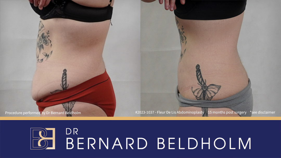 Fleur de Lis Abdominoplasty After Loosing 50kg of Weight (Patient 2023-1037) - Right Side