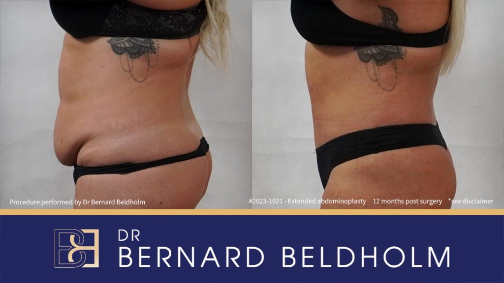 Abdominoplasty Post Weight Loss with VASER Liposuction (Suction-assisted Lipectomy) and Diastasis Recti Repair (Patient 2023-1021) - Right Side