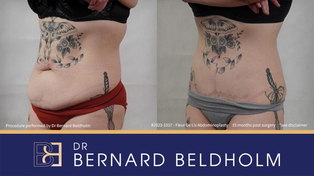 Fleur de Lis Abdominoplasty After Loosing 50kg of Weight (Patient 2023-1037) - Right