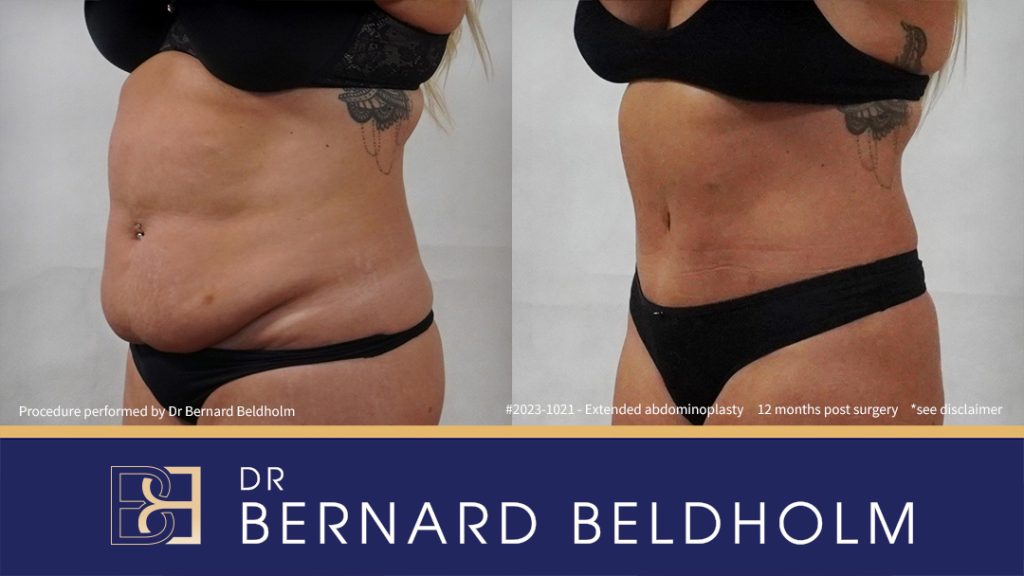 Abdominoplasty Post Weight Loss with VASER Liposuction (Suction-assisted Lipectomy) and Diastasis Recti Repair (Patient 2023-1021) - Right