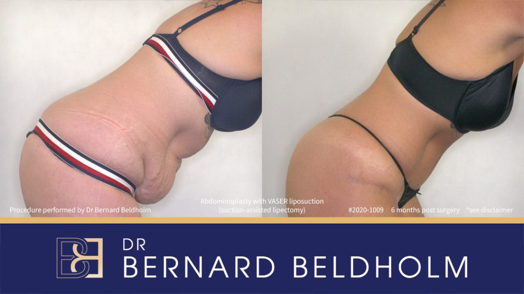 Abdominoplasty with VASER Liposuction (Suction-assisted Lipectomy) (Patient 2020-1009) - Left Side Bend