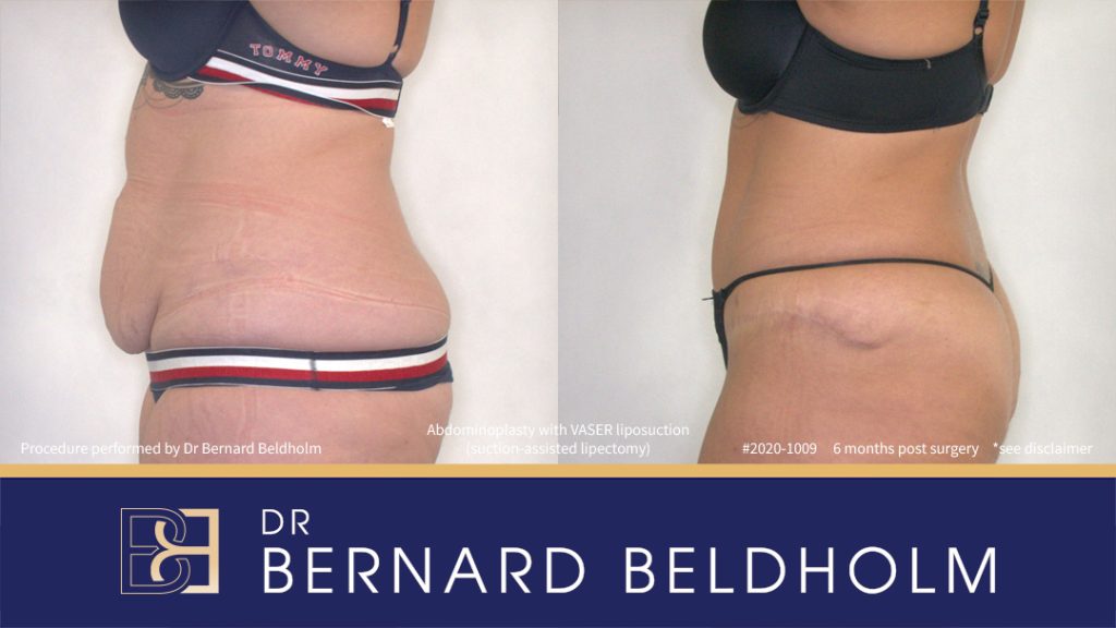 Abdominoplasty with VASER Liposuction (Suction-assisted Lipectomy) (Patient 2020-1009) - Right Side