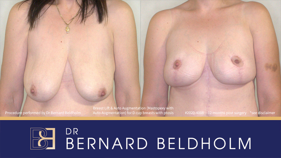 Breast Lift (Mastopexy) for D Cup Breasts with Ptosis (Patient 2020-4008) - Front
