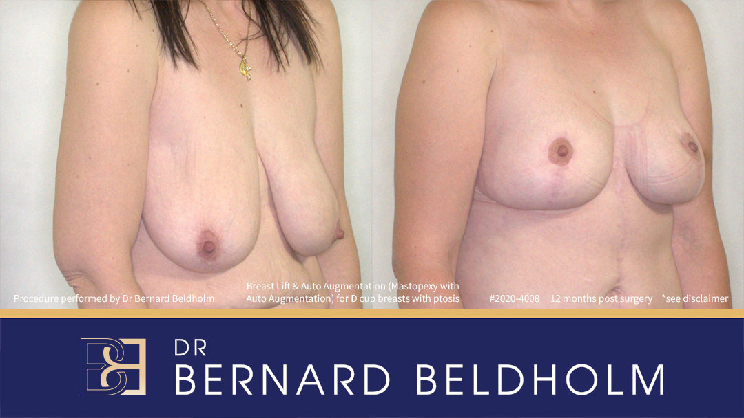 Mastopexy (Breast Lift) Patient 2020-4008 2 Breast Lift (Mastopexy) for D Cup Breasts with Ptosis (Patient 2020-4008) - Left