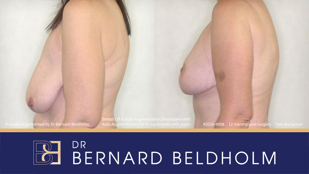 Mastopexy (Breast Lift) Patient 2020-4008 3 Breast Lift (Mastopexy) for D Cup Breasts with Ptosis (Patient 2020-4008) - Right Side