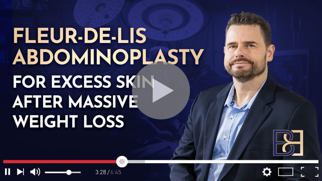 Fleur-de-Lis Abdominoplasty for Excess Skin After Massive Weight Loss