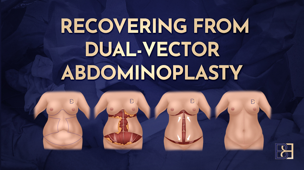 Recovering from Dual-Vector Abdominoplasty