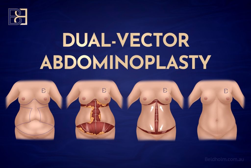 Dual-Vector Abdominoplasty