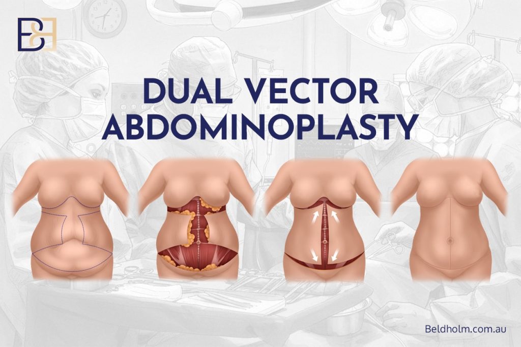 Excess Skin After Weight Loss – Surgical Options for the Abdomen and Lower Torso 10 Dual Vector Abdominoplasty