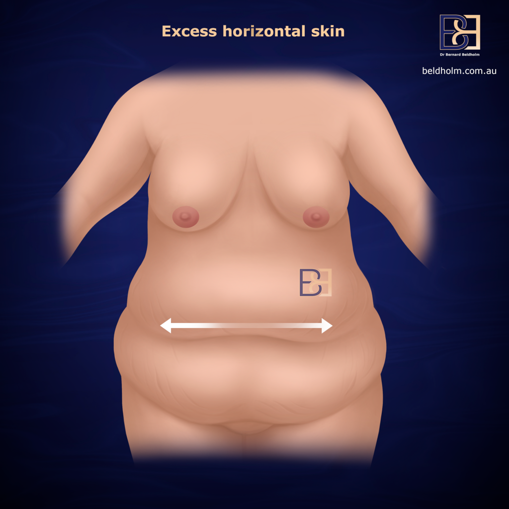 Excess horizontal skin - Dual Vector