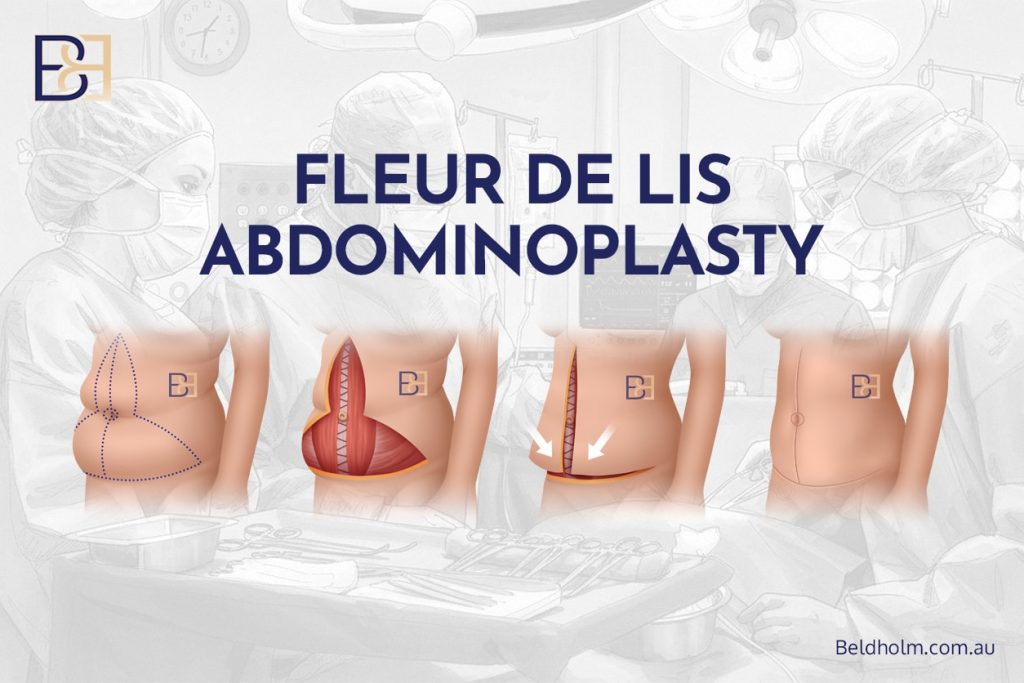 Excess Skin After Weight Loss – Surgical Options for the Abdomen and Lower Torso 9 Fleur-de-Lis Abdominoplasty