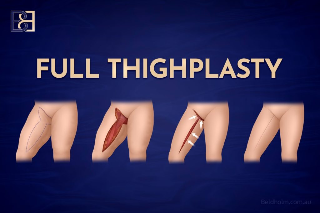 Full Thigh Lift (thighplasty) (Vertical and Horizontal Components)