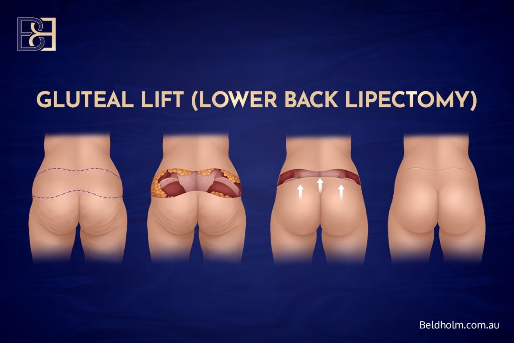 Gluteal lift or lower back lipectomy