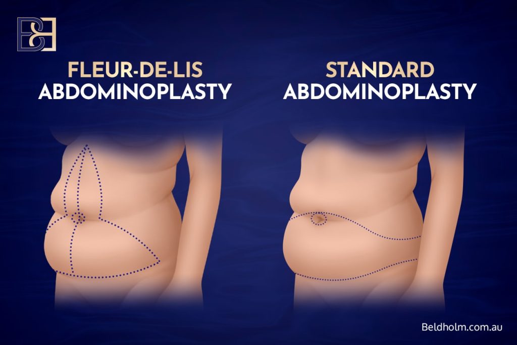How a Fleur-de-Lis Differs from a Standard Abdominoplasty