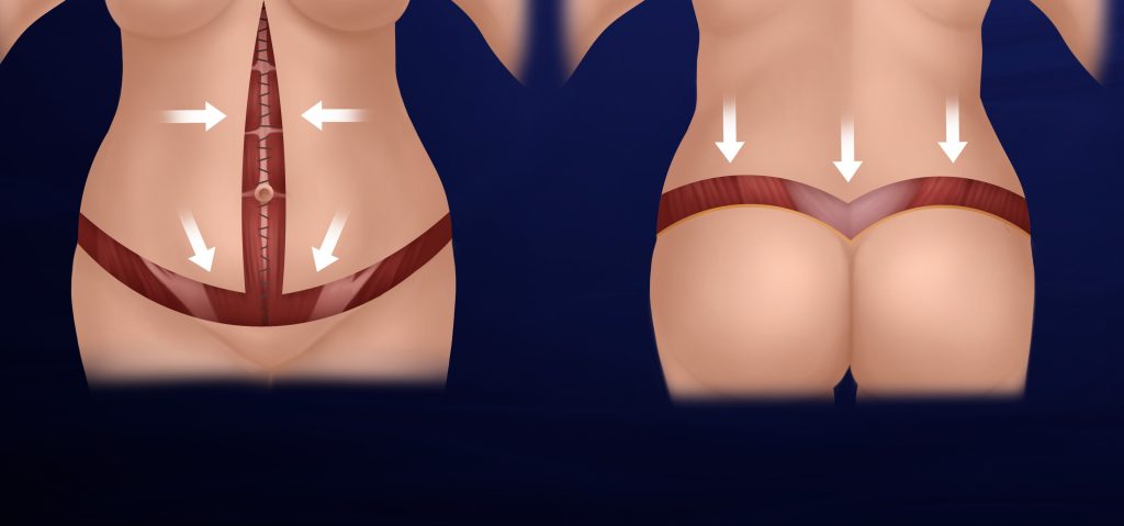 Excess Skin After Weight Loss – Surgical Options for the Abdomen and Lower Torso 12 Hybrid Circumferential Approach