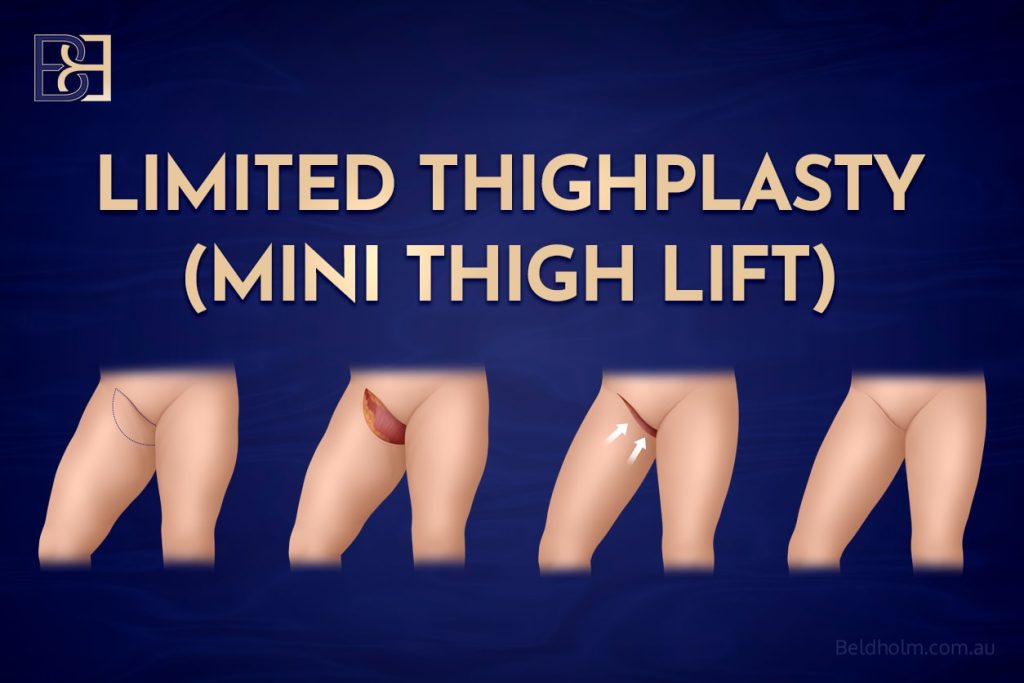 Limited Thighplasty (Mini Thigh Lift)