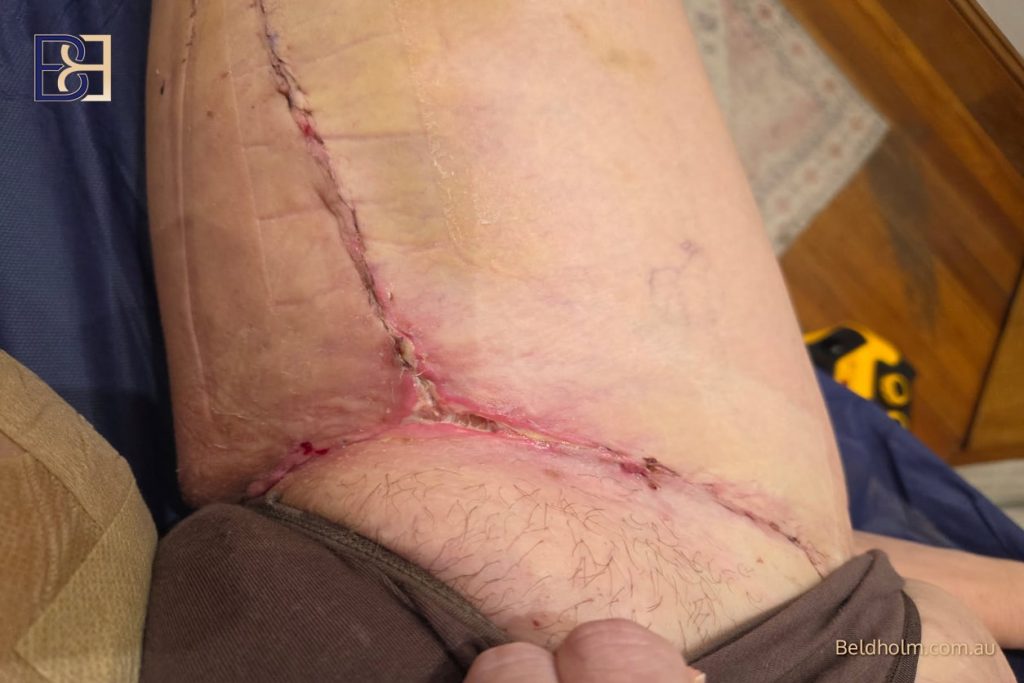 Poor and Delayed Wound Healing