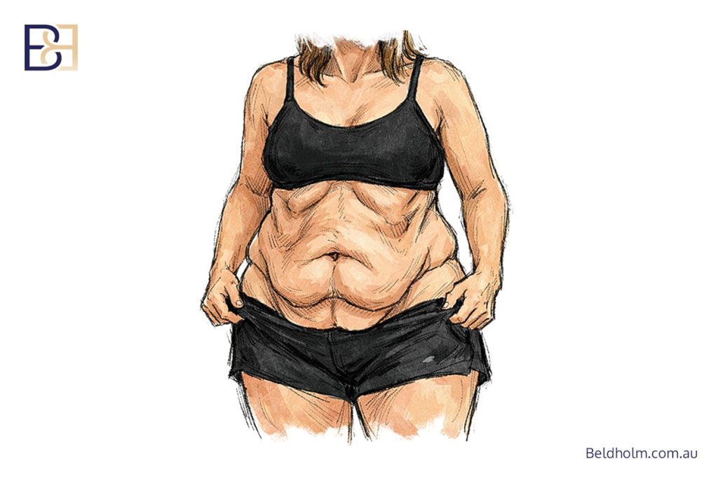 Tummy Tuck After Weight Loss (Abdominoplasty) 3 Post weight loss loose skin