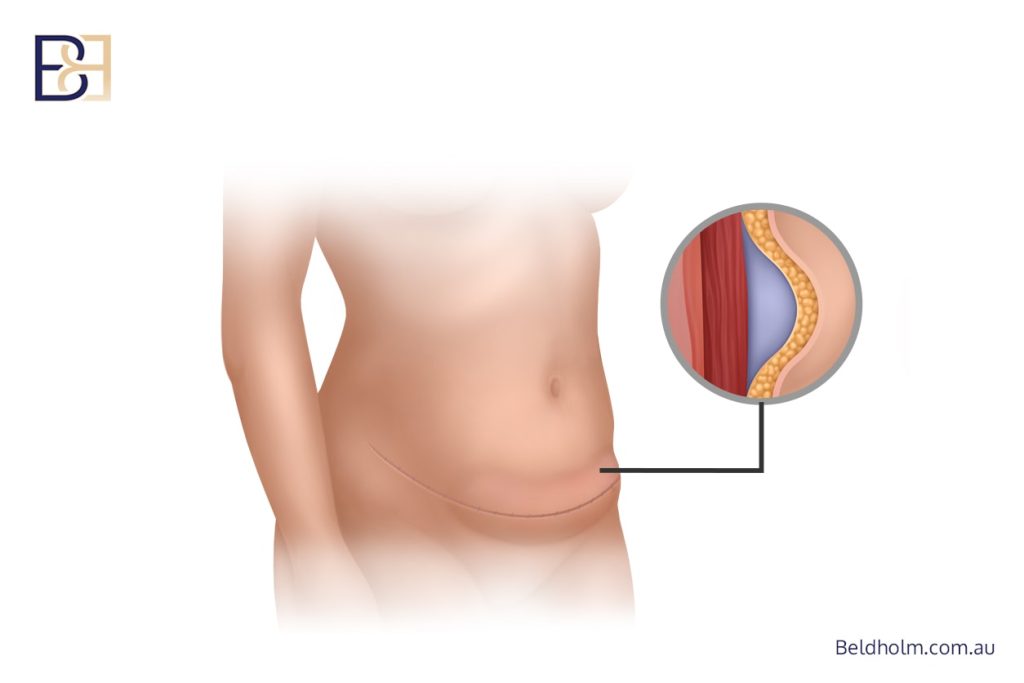 Tummy Tuck After Weight Loss (Abdominoplasty) 15 Potential Risks and Complications