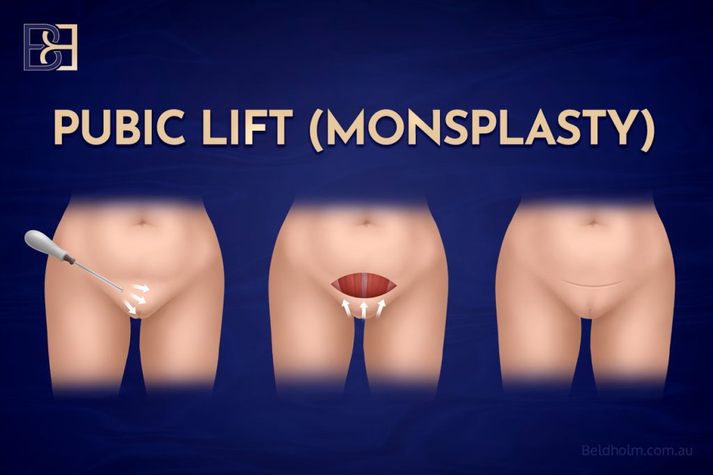 Pubic Lift - Monsplasty